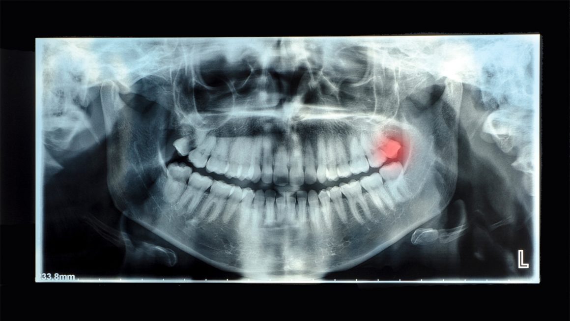 ผ่าฟันคุด