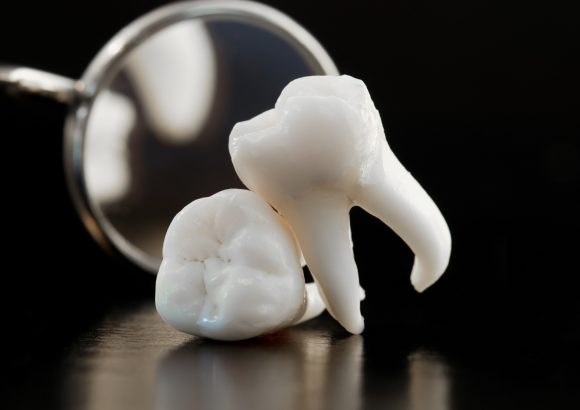 ผ่าฟันคุด