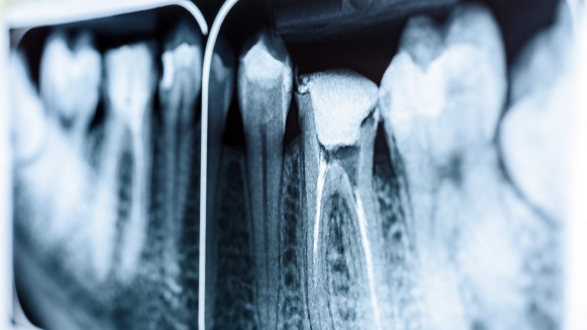 รักษารากฟัน Root canal treatment / cutting off the tip of the tooth root