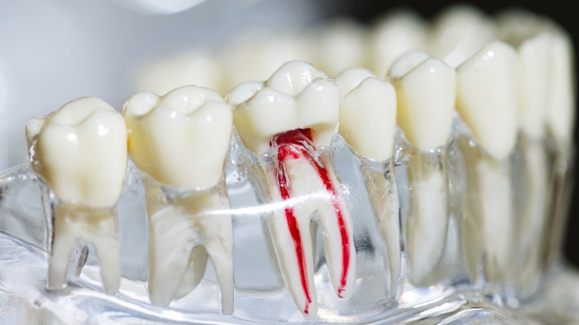 รักษารากฟัน Root canal treatment / cutting off the tip of the tooth root