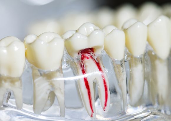 รักษารากฟัน / ตัดปลายรากฟัน