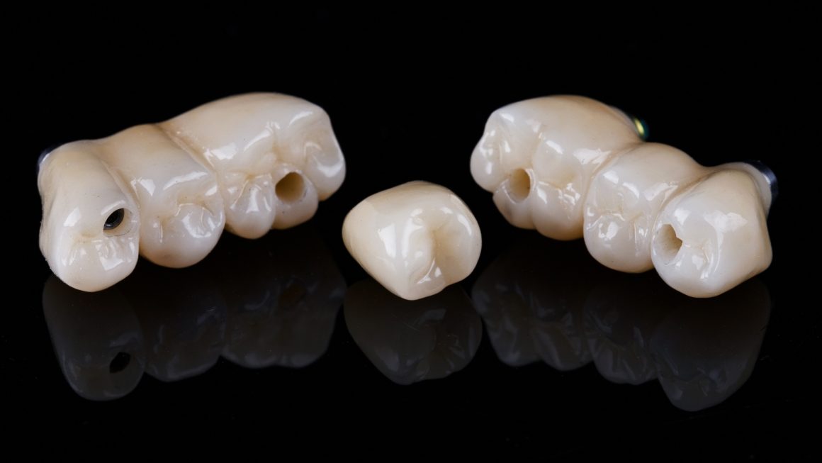 ครอบฟัน เเละ สะพานฟัน