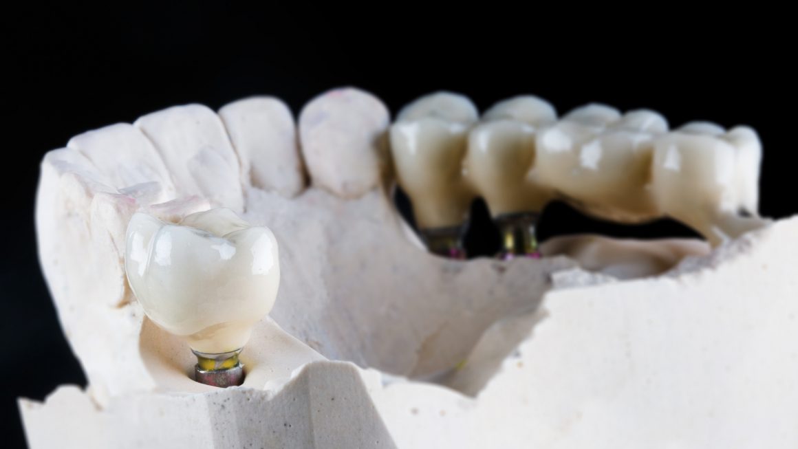 ครอบฟัน เเละ สะพานฟัน