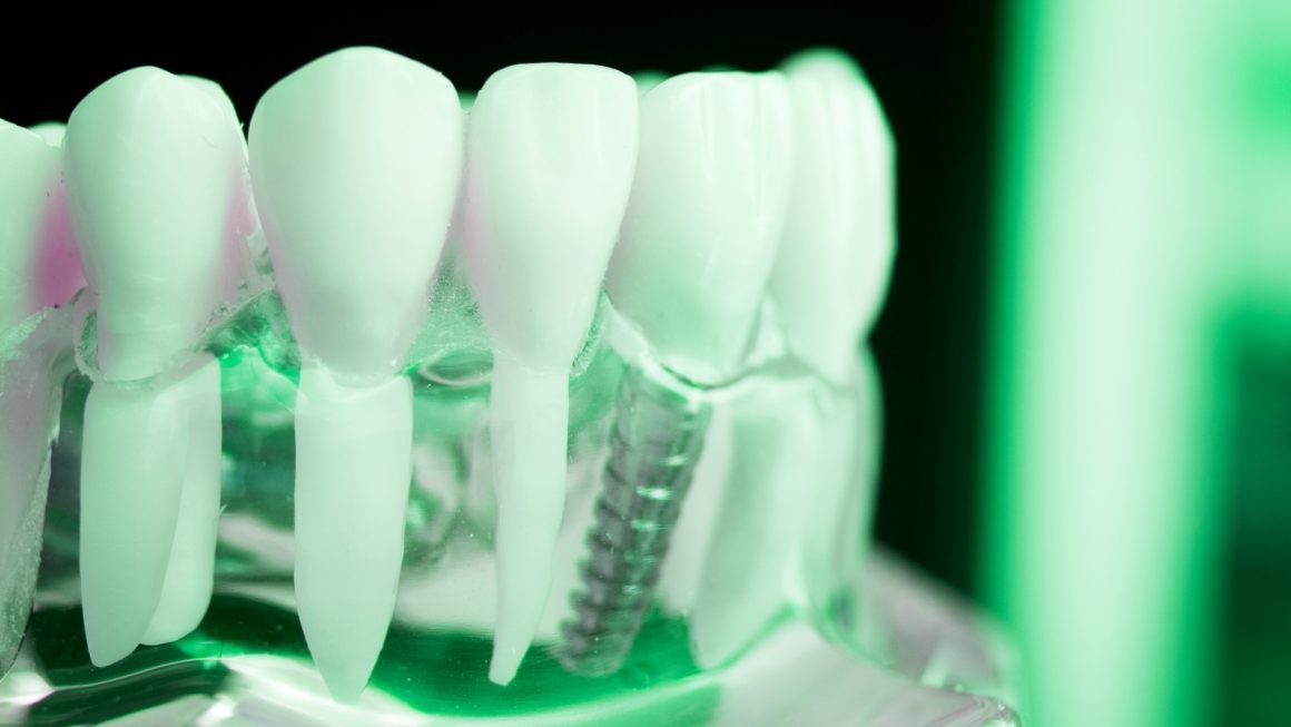 Dental implants