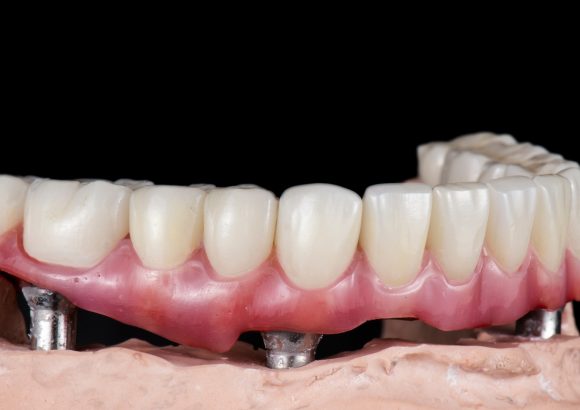 รากฟันเทียมทั้งปากดียังไง