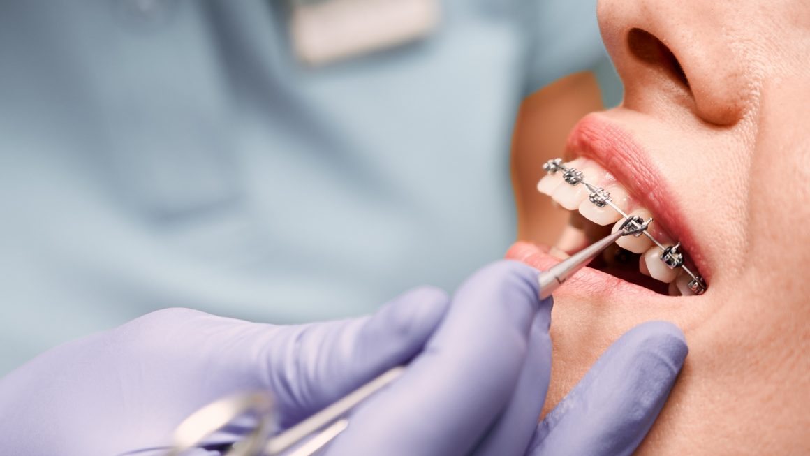 จัดฟันใส / จัดฟันแบบลวด