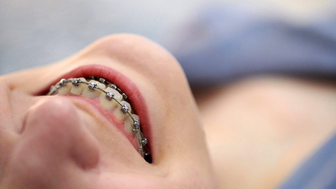 wires Clear braces/wires (Orthondotic Treatment)