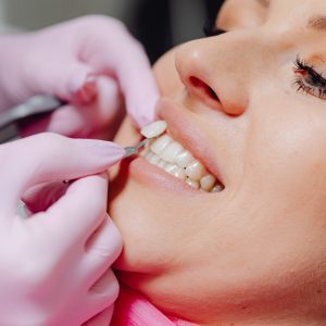 วีเนียร์