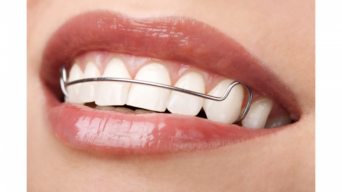 รีเทนเนอร์ลวด A wire retainer