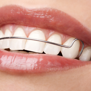 รีเทนเนอร์แบบลวด